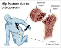 osteoporosis-2